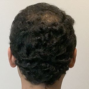 Fue Hair Transplant 05