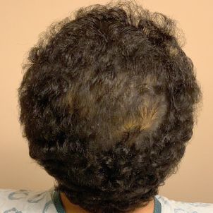 Fue Hair Transplant 07