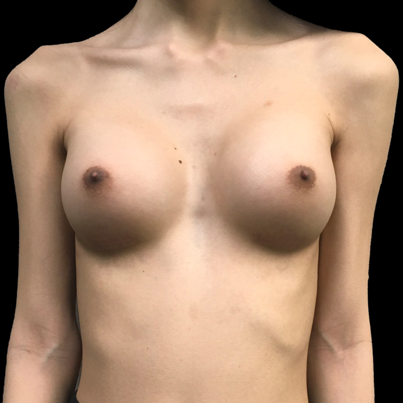 Gummy Bear Implants 02