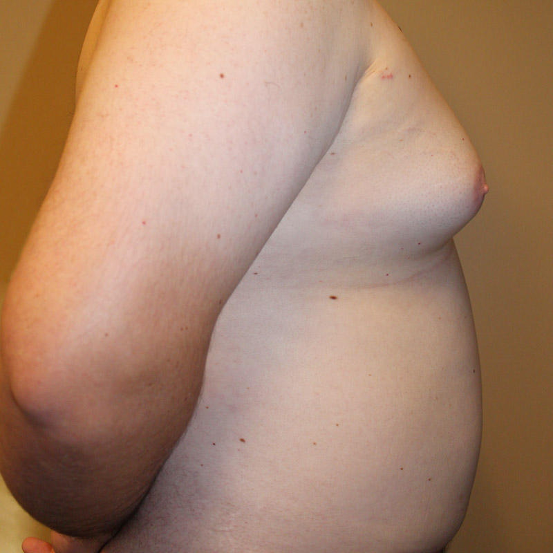 Gynecomastia 03