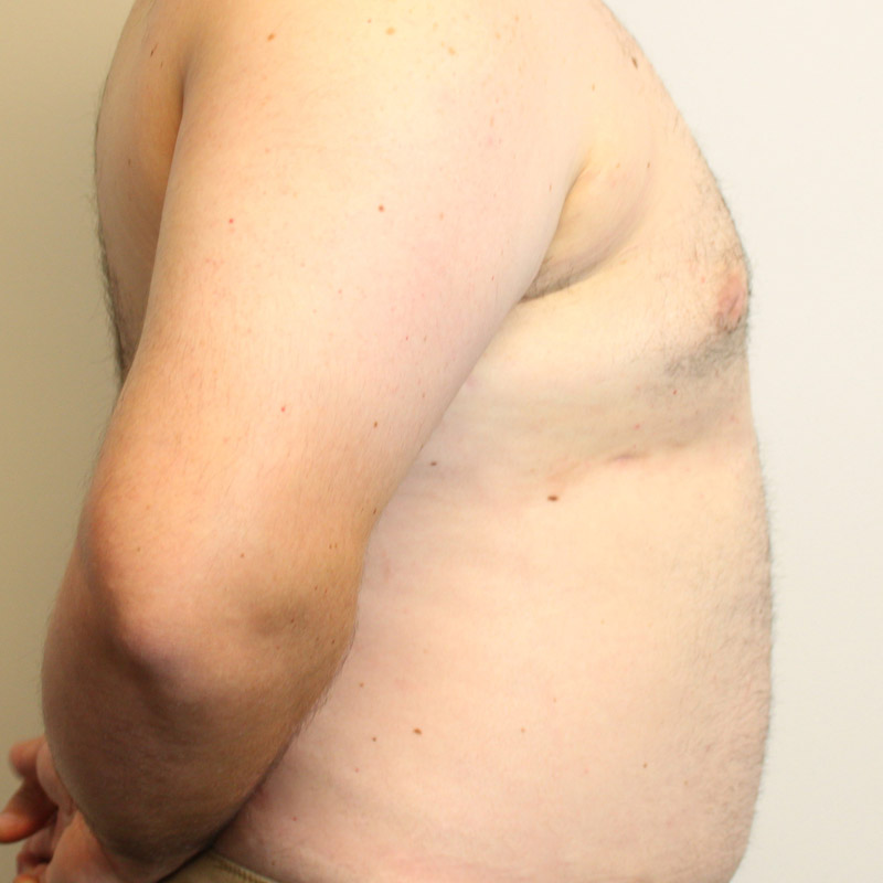 Gynecomastia 03