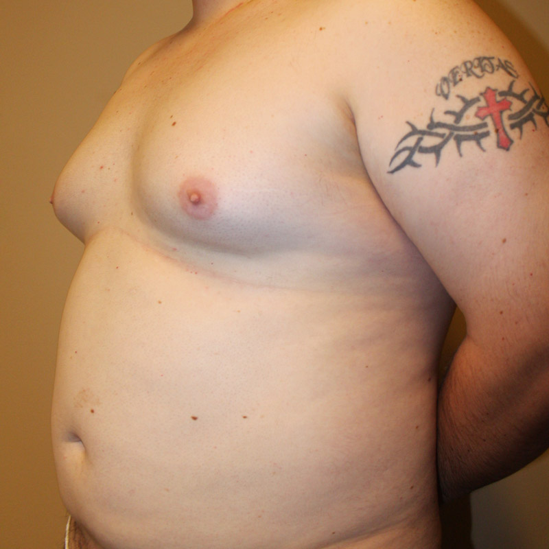 Gynecomastia 07