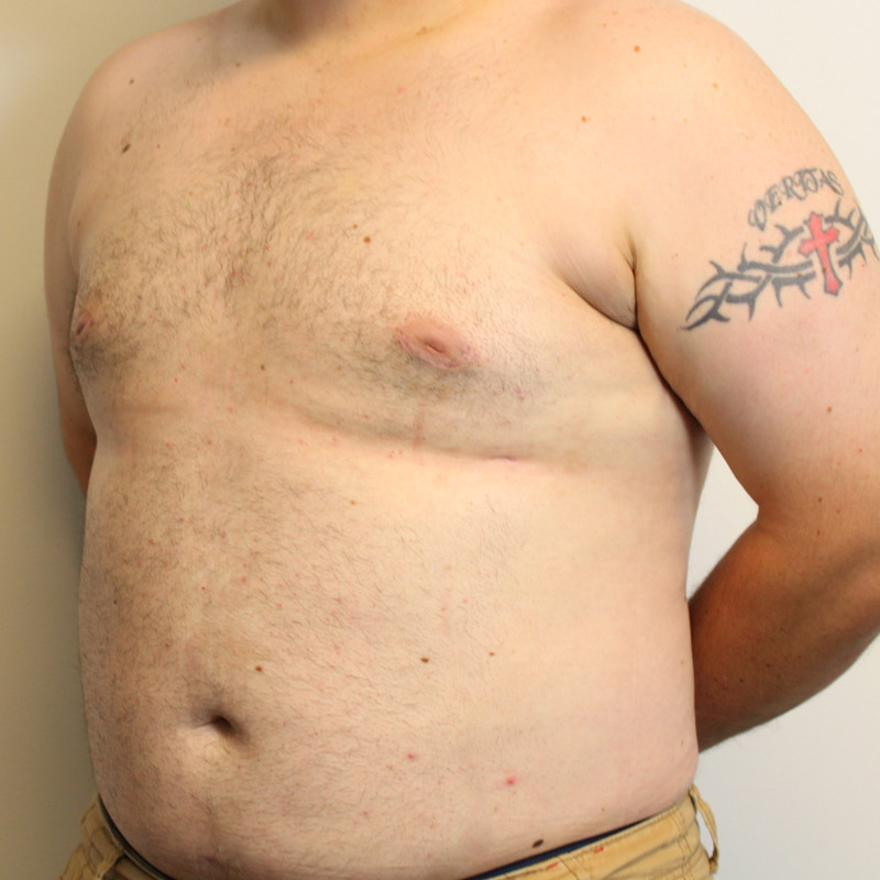 Gynecomastia 07