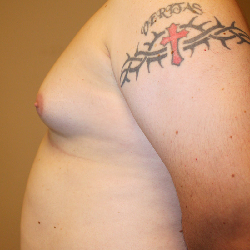 Gynecomastia 09