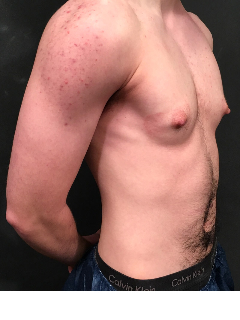 Gynecomastia 03