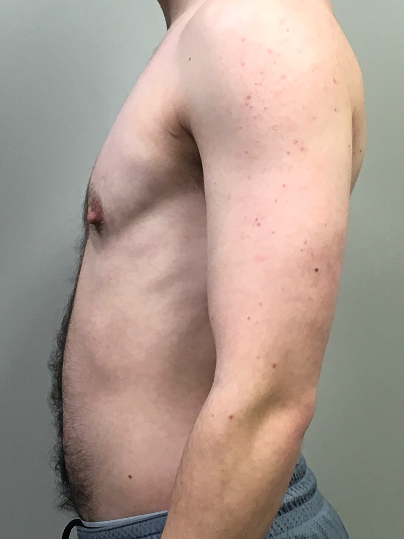 Gynecomastia 05