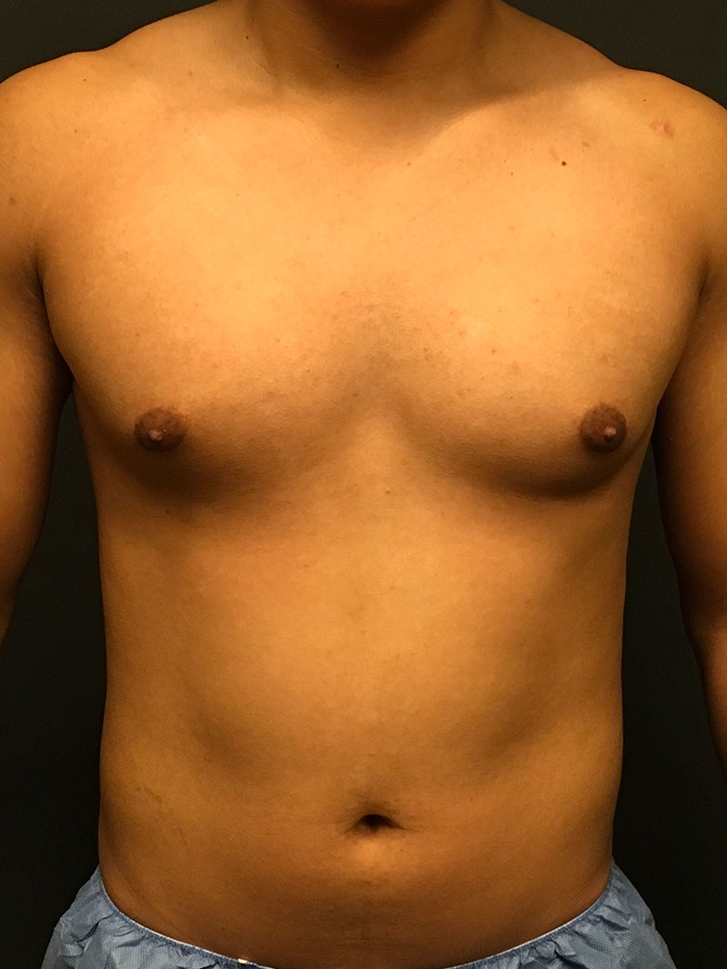 Gynecomastia 01