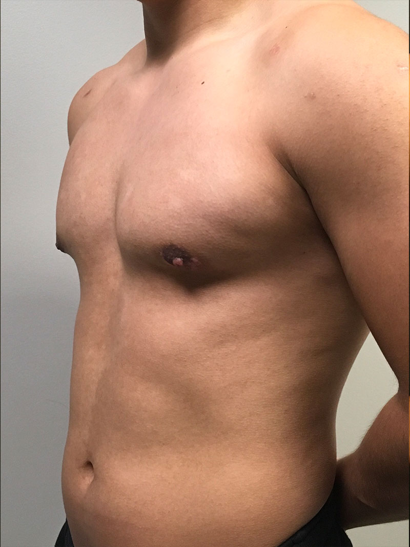 Gynecomastia 03