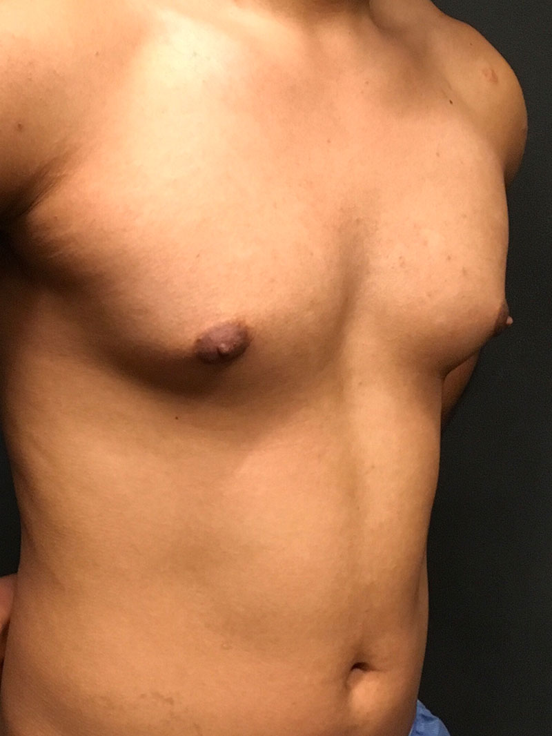 Gynecomastia 05