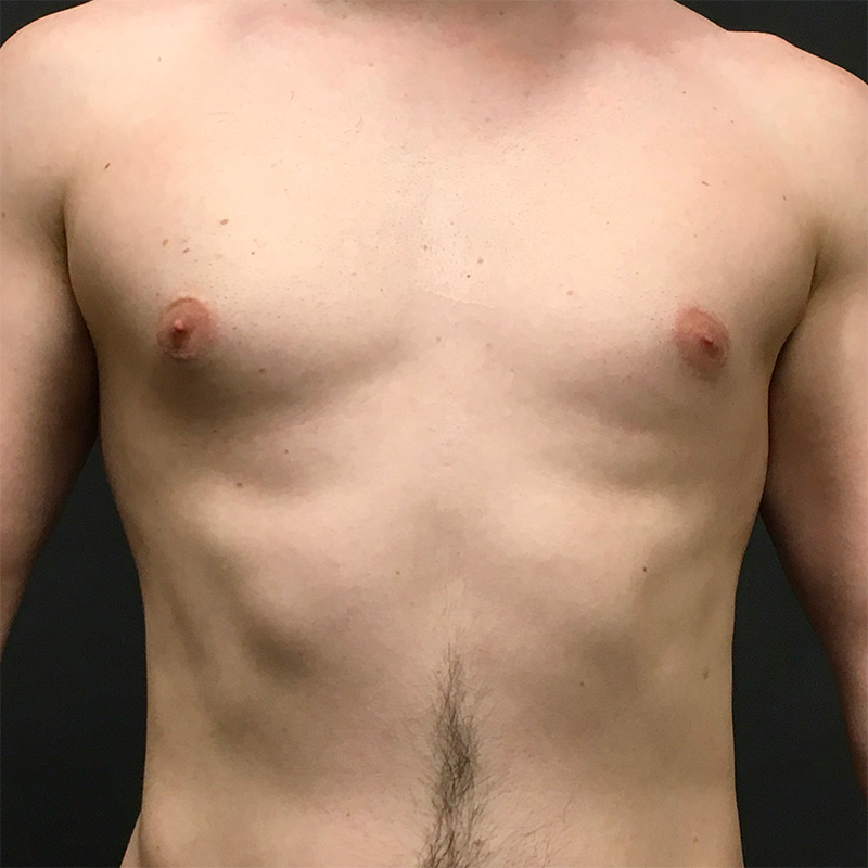 Gynecomastia 01