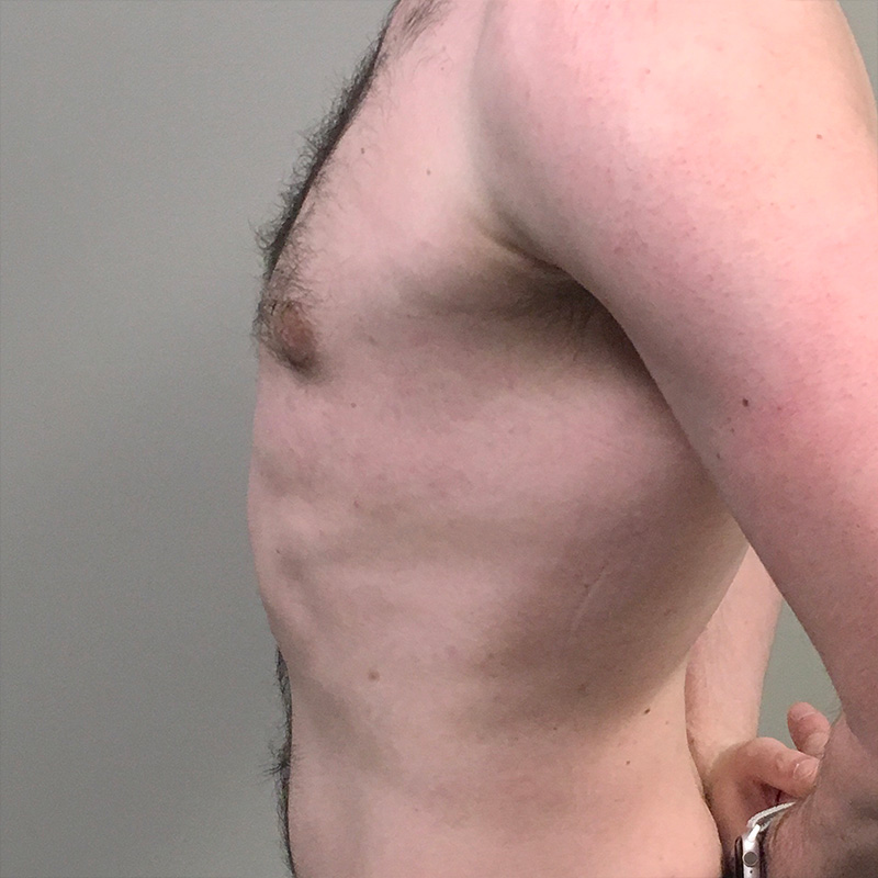 Gynecomastia 03