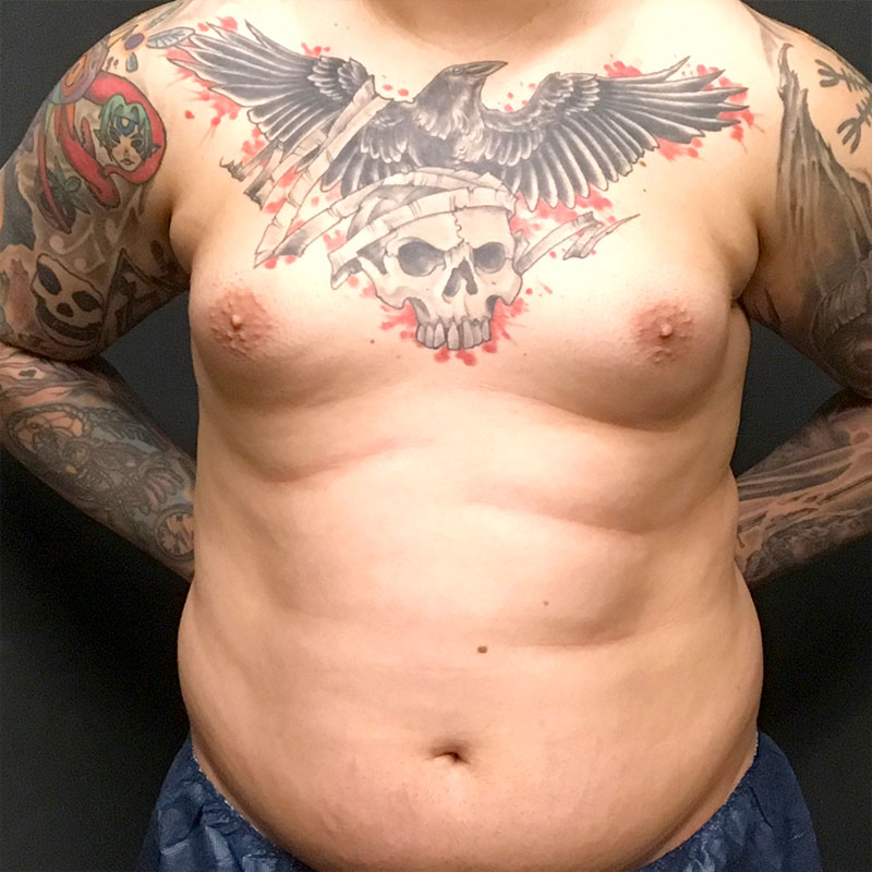 Gynecomastia 01