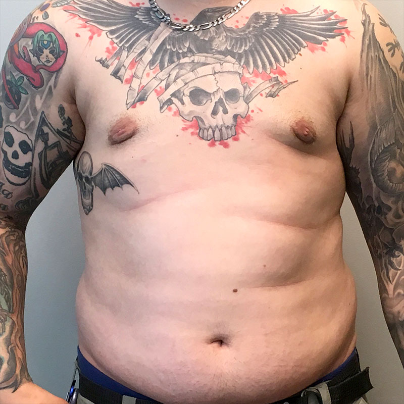 Gynecomastia 05