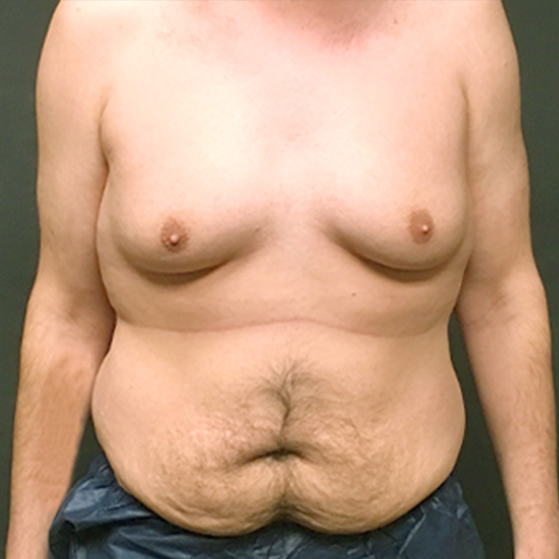 Gynecomastia 01