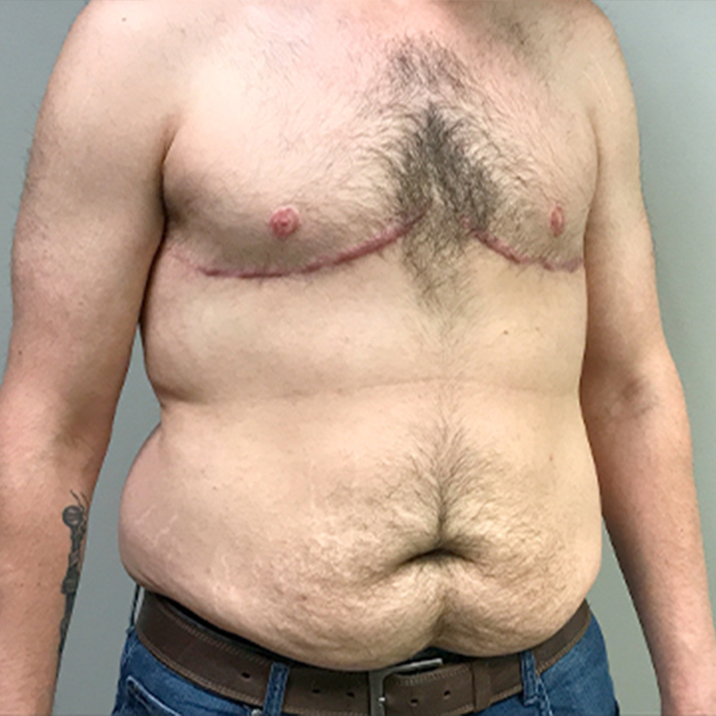 Gynecomastia 03