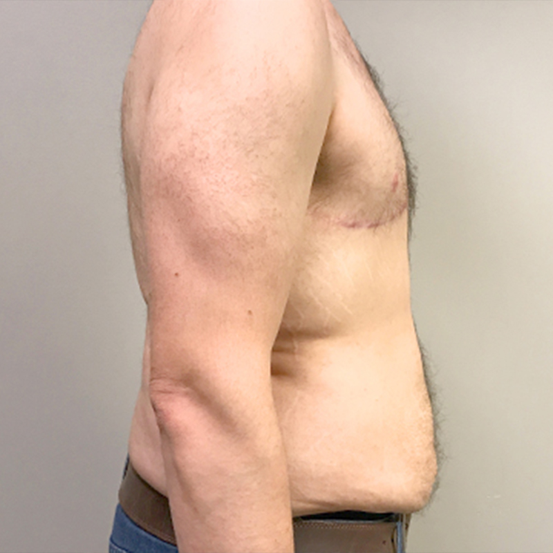 Gynecomastia 05