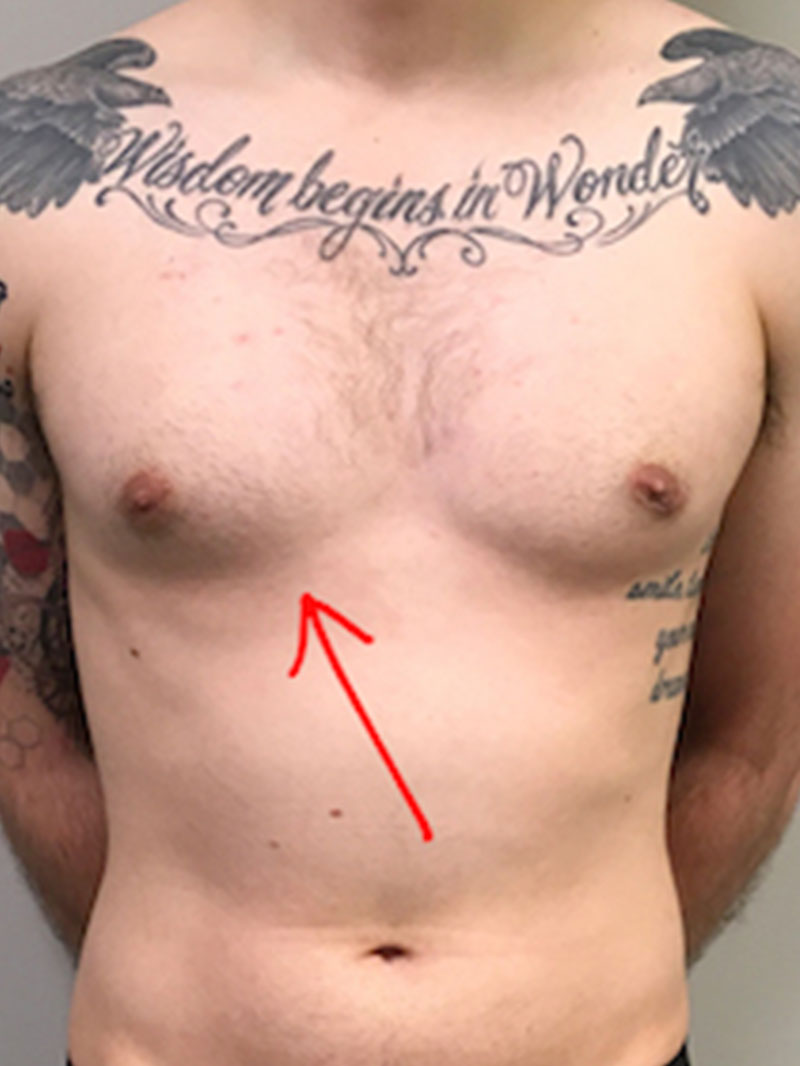 Gynecomastia 07