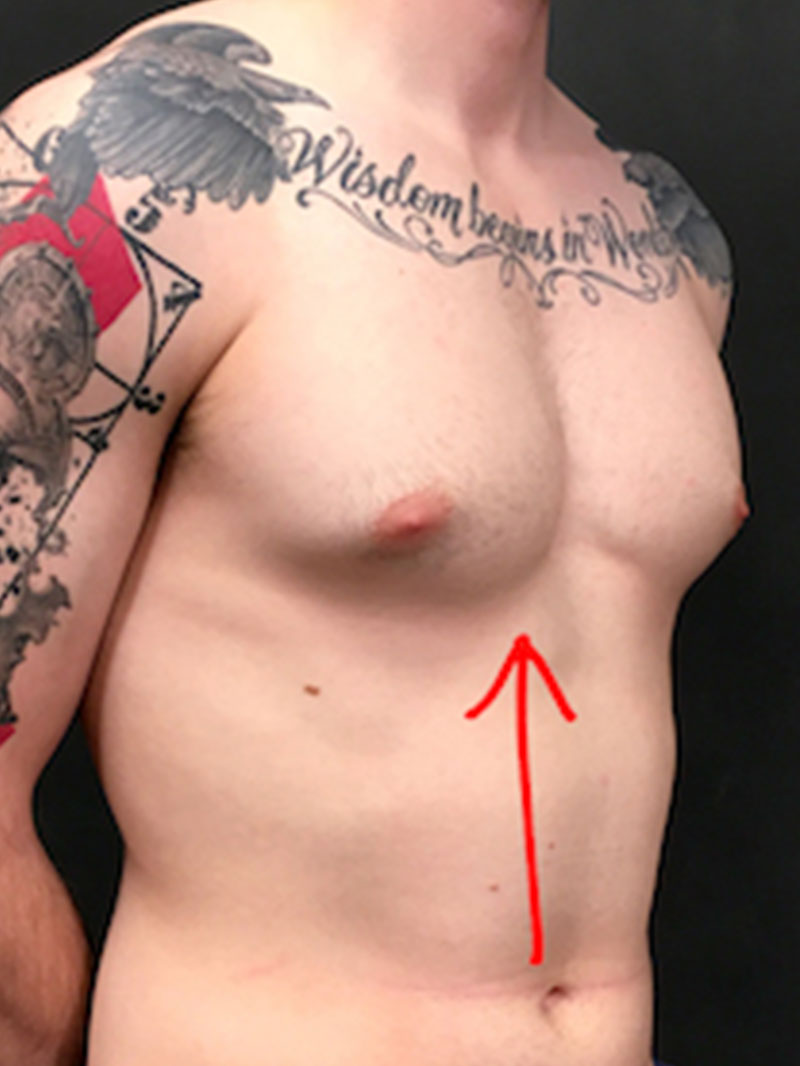 Gynecomastia 03