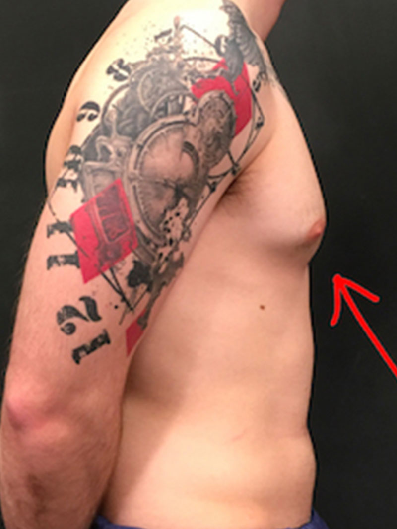 Gynecomastia 05