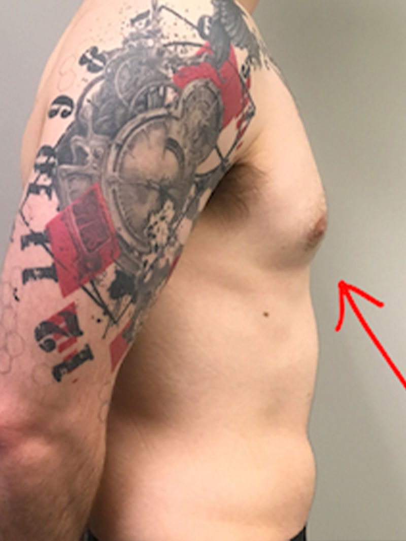 Gynecomastia 05