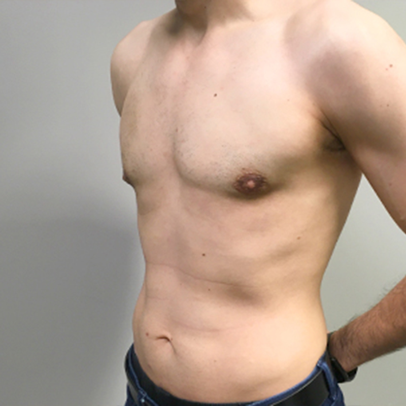 Gynecomastia 08