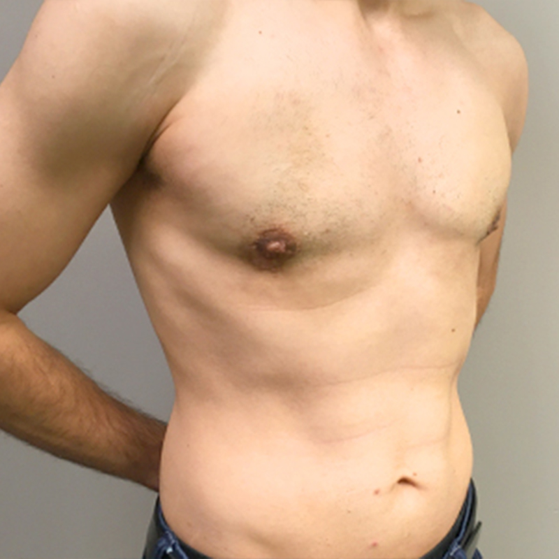 Gynecomastia 05