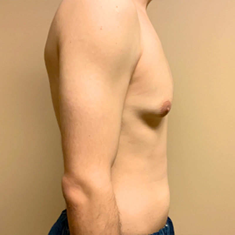 Gynecomastia 07