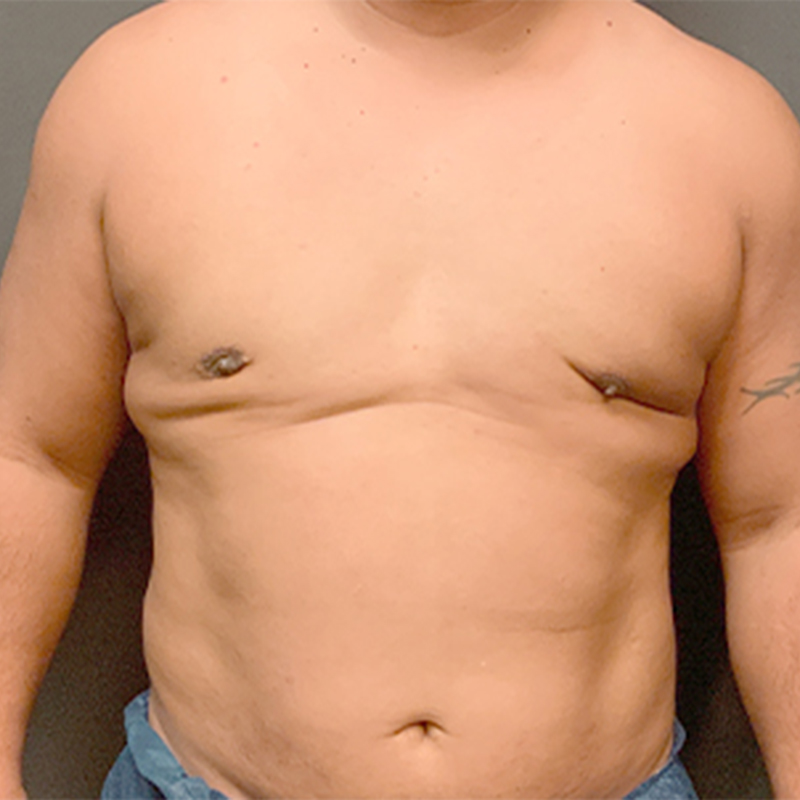 Gynecomastia 01