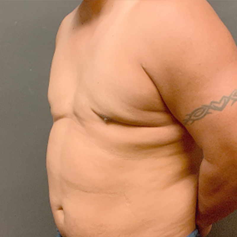 Gynecomastia 03