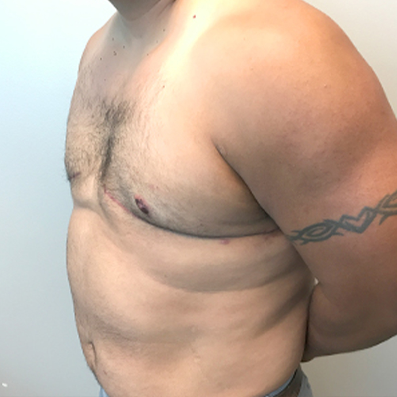 Gynecomastia 03