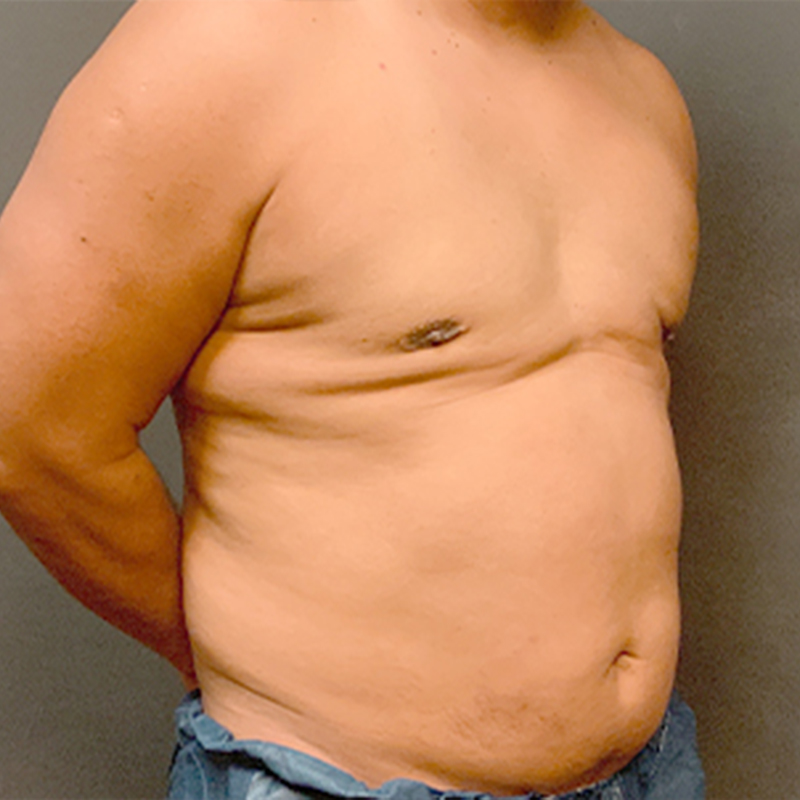 Gynecomastia 07