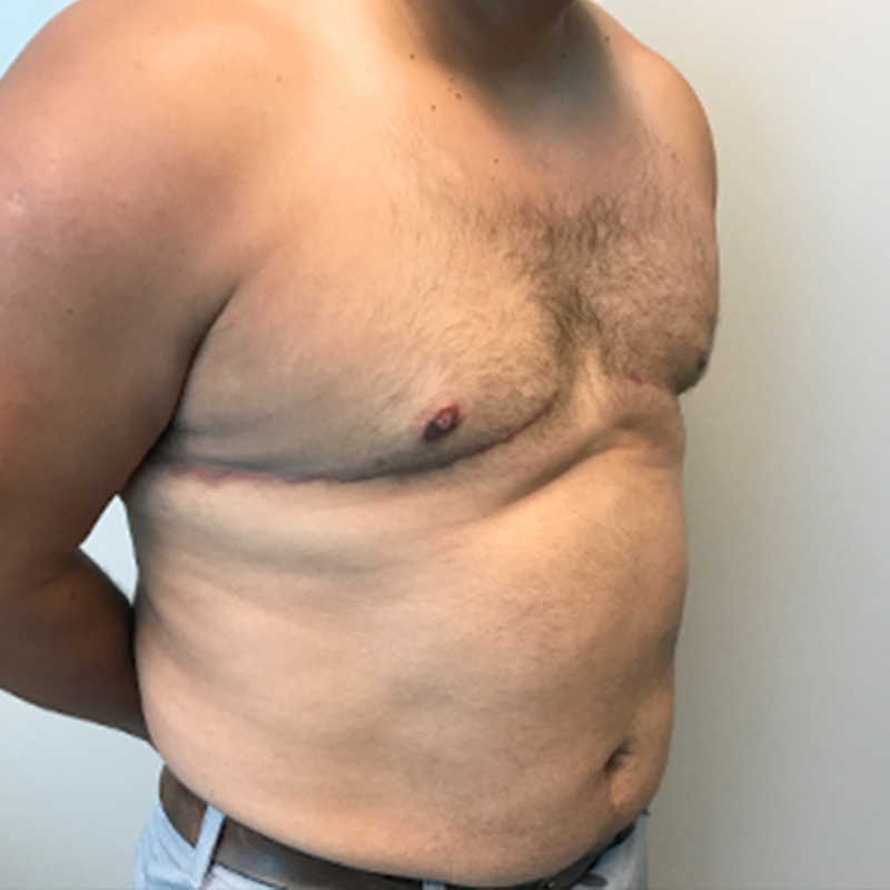 Gynecomastia 07