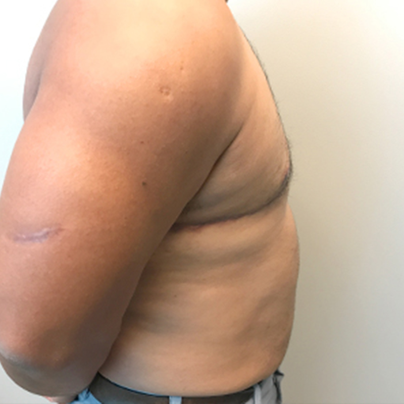 Gynecomastia 09