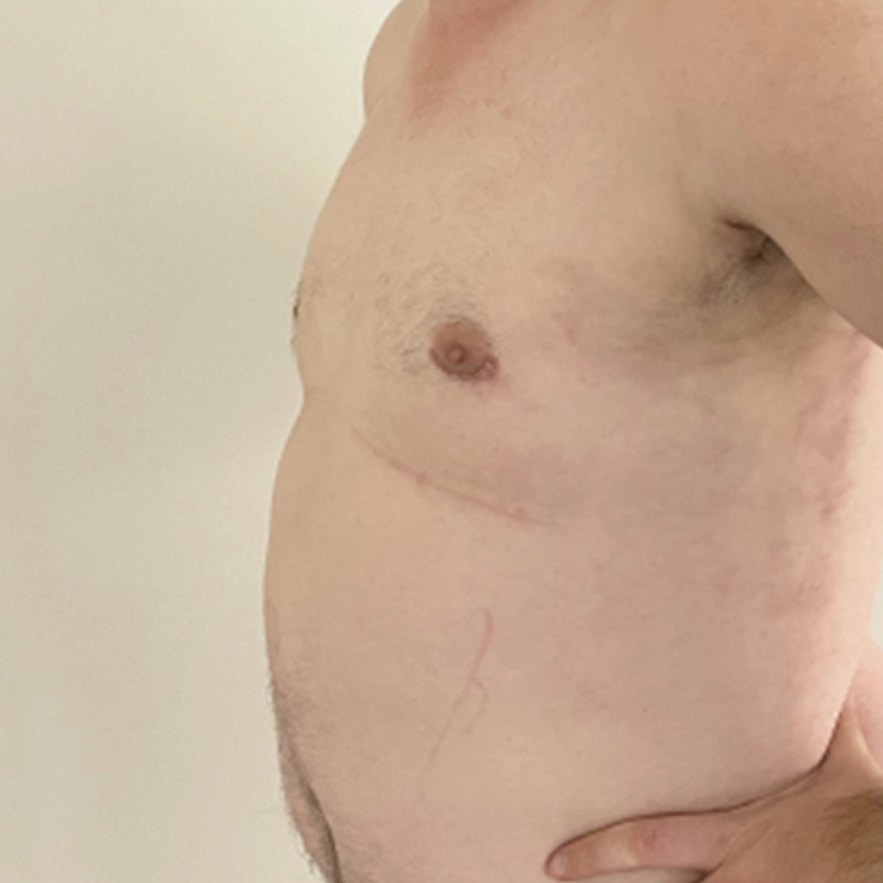 Gynecomastia 03