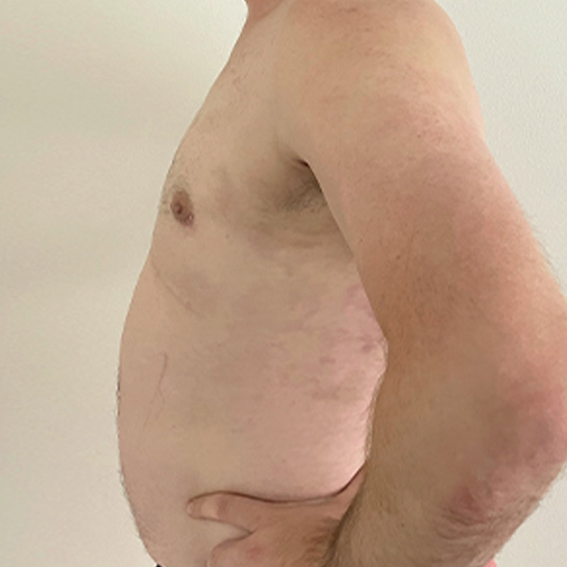 Gynecomastia 05