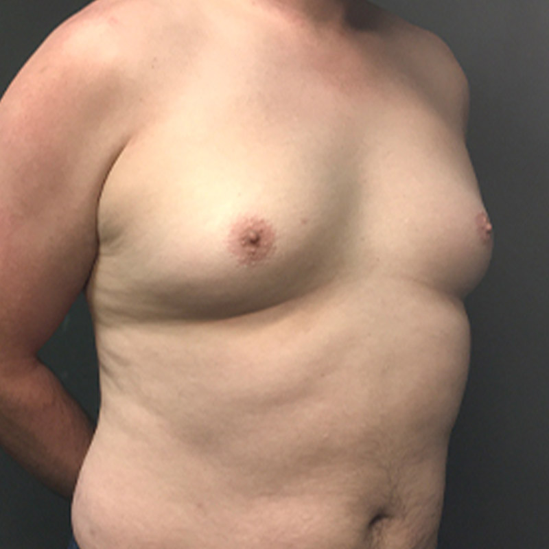 Gynecomastia 07