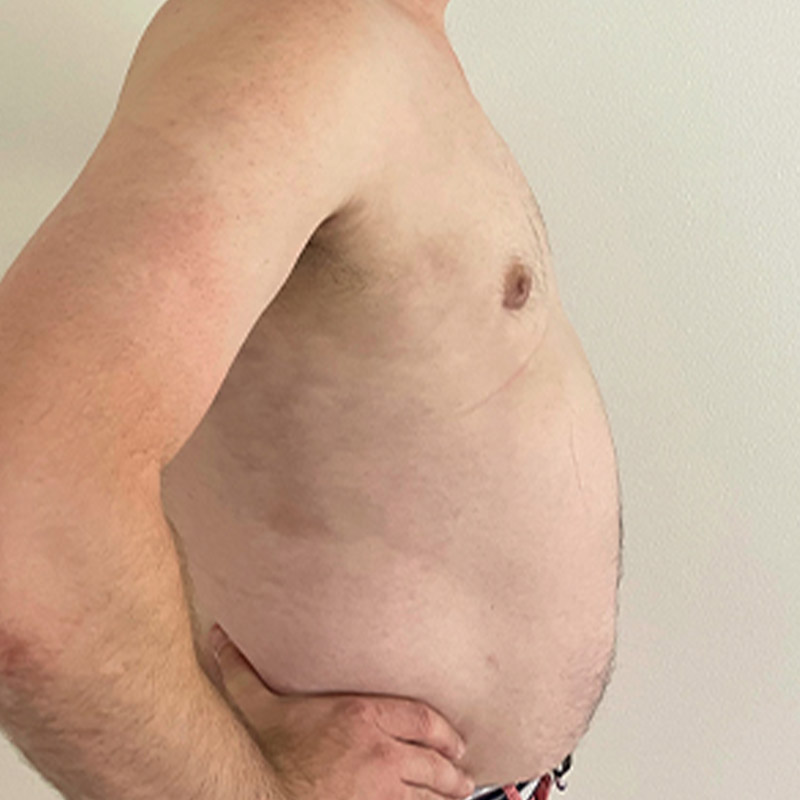 Gynecomastia 09