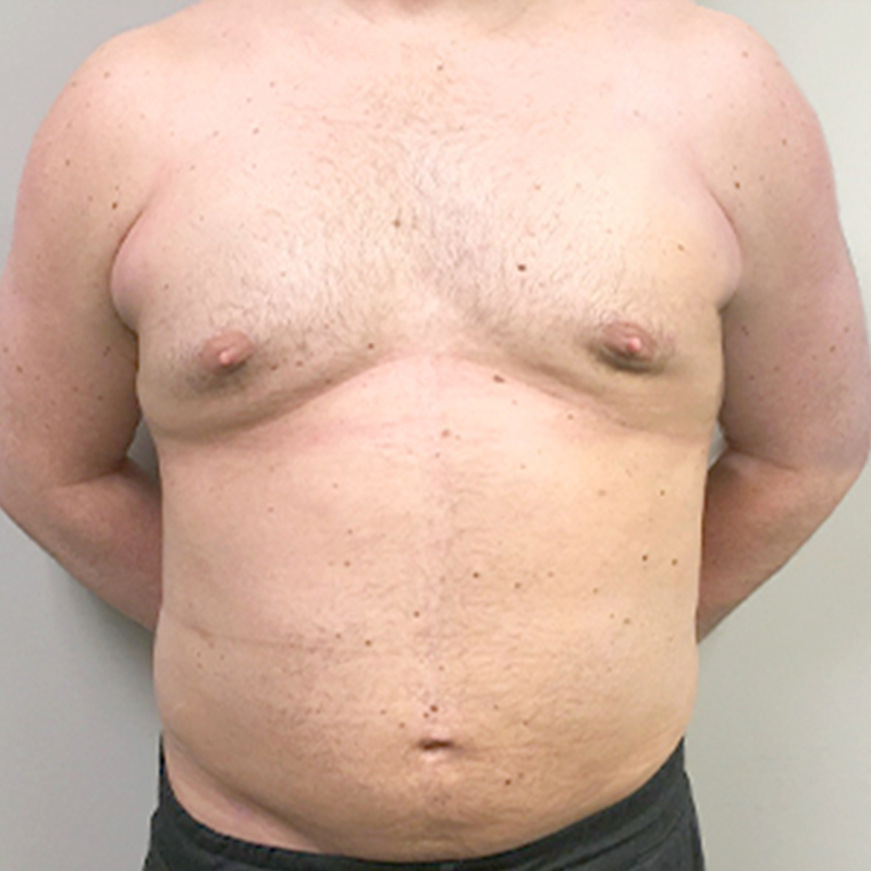 Gynecomastia 11