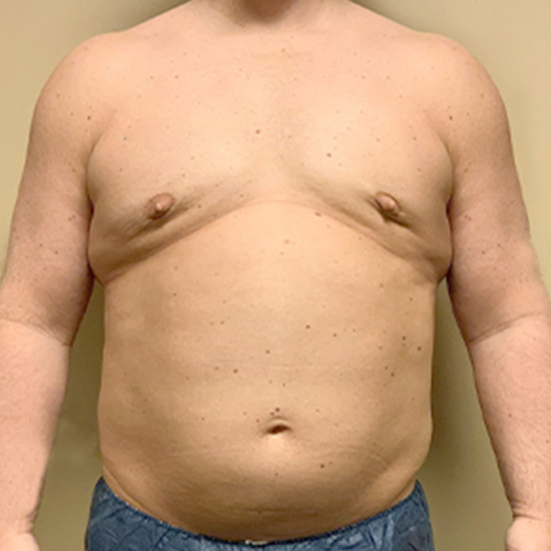 Gynecomastia 07