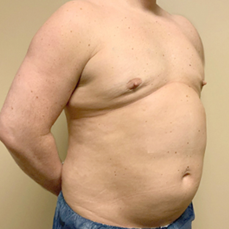 Gynecomastia 09