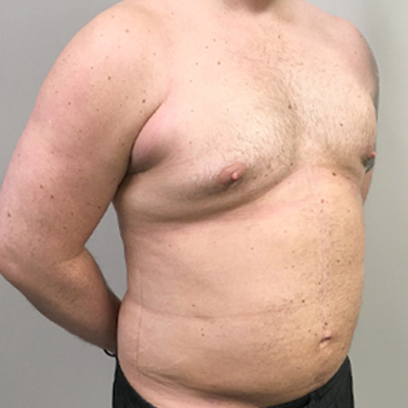 Gynecomastia 09