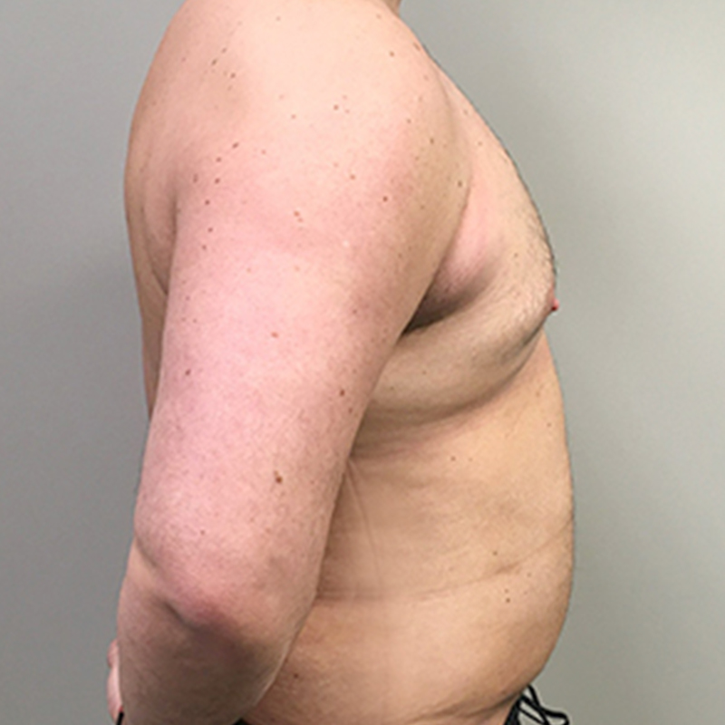 Gynecomastia 11
