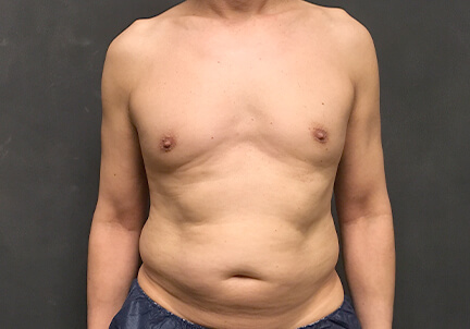 Gynecomastia 01