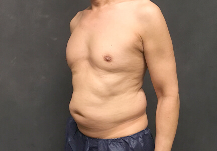 Gynecomastia 03