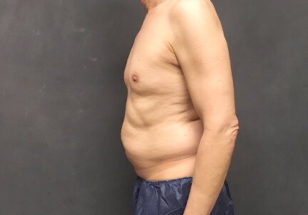 Gynecomastia 05