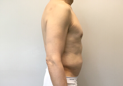 Gynecomastia 07