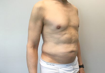 Gynecomastia 09