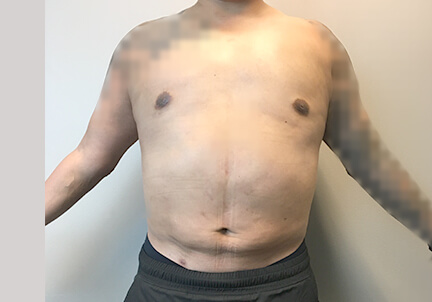 Gynecomastia 13