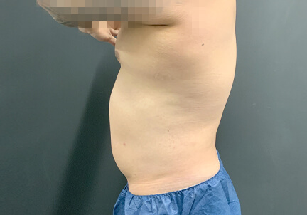 Gynecomastia 03