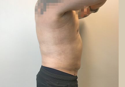 Gynecomastia 05